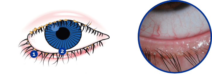 Dry eye treatment graphic