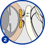 Dry eye disease treatment stage 2