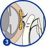 Dry eye disease treatment stage 3