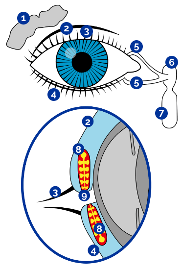 Dry eye disease graphic