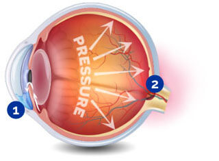 Glaucoma